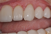 6 Guidelines to Avoid Post-Cementation Fracture