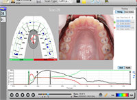 Occlusal Finishing: Two Paper Technique
