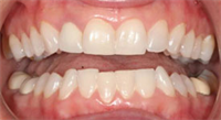 Invisalign Treatment + Emprethins = Maximum Aesthetics - #smilestories