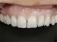 Tools for Achieving Ideal Gingival Architecture