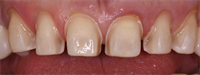 Anterior Veneer Prep for Closing Black Triangles 