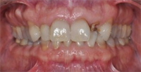 Peri-Implant Esthetics Treatment Planning