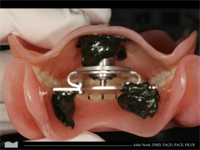 Dentures without the Guesswork