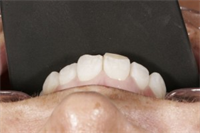 First Steps: Ceramic Porcelain Fracture Guidelines