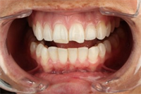 Setting Up The Occlusion: Ceramic Porcelain Fracture Guidelines #1