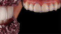 Gum Symmetry: The Seventh Violation of Smile Design