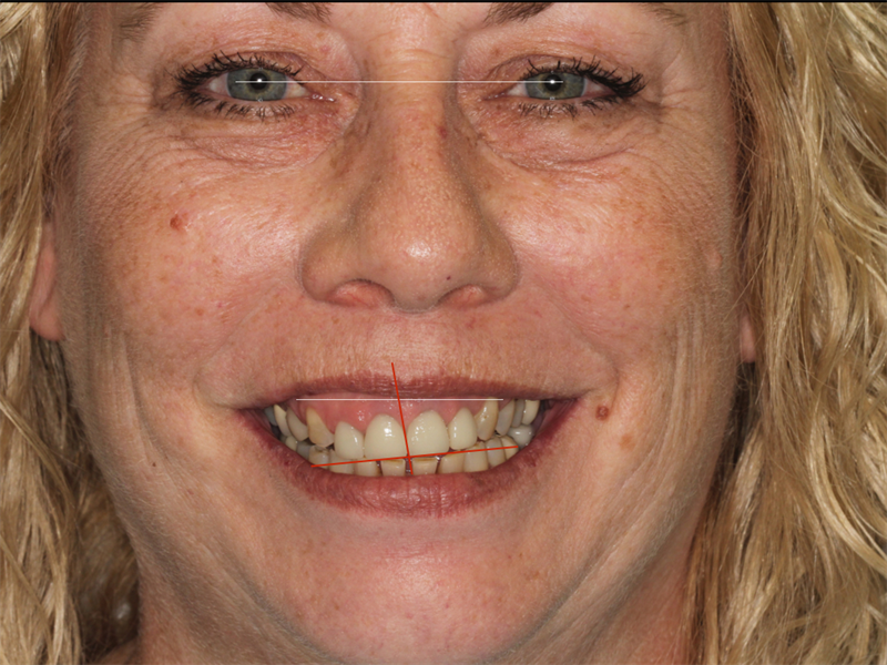 Aesthetic Full Mouth Rehab ... Where to Learn?