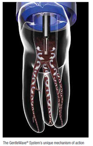 GentleWave by Sonendo: A Second Look