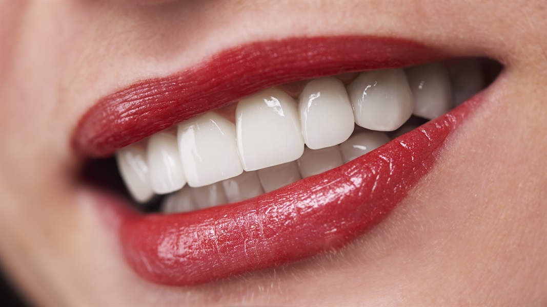Porcelain Veneers For A Beautiful Smile
