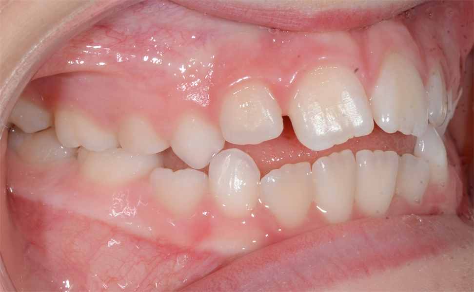  Orthodontics: How You Start Finishing at the Beginning and Reduce the Stress at the End for You and Your Patient