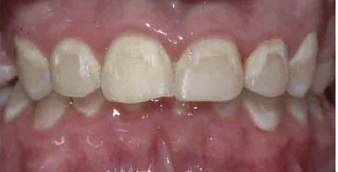 White Spot Lesions: Three Factors of Interplay