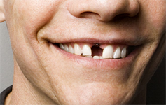 Dentaltown Learning Online....Latest Tooth Replacement Techniques with Cerec. Recorded Live at Townie Meeting 2014!