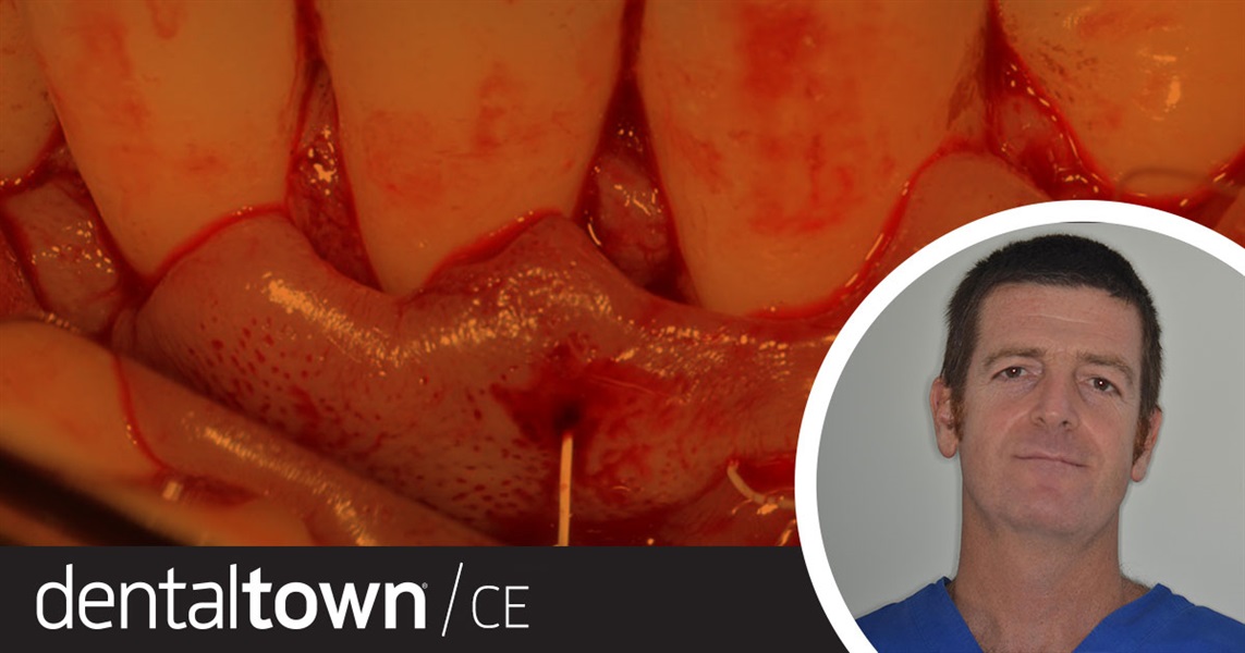 Dentaltown Learning Online....Guided Tissue Regeneration: Principles and Surgical Protocols. By Dr. Giacomo Tarquini