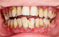 Dentaltown Learning Online....Repair and Protect Enamel with Remineralizing Agents by Deborah Levin-Goldstein, RDH, MS 