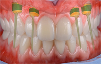 Dentaltown Learning Online...."Success with Zr Removable Telescopic Implant Prosthesis" by Arian Deutsch, CDT. 