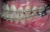 Dentaltown Learning Online....Orthodontics in the Multidisciplinary Treatment of Complex Cases by Dr. Miguel Hirschhaut