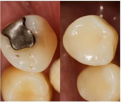 Should I Replace My Silver Fillings with White Ones? Here is What You Need to Know