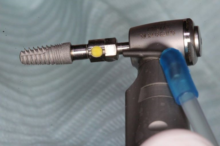 052 Single Implant Placement For the General Dentist