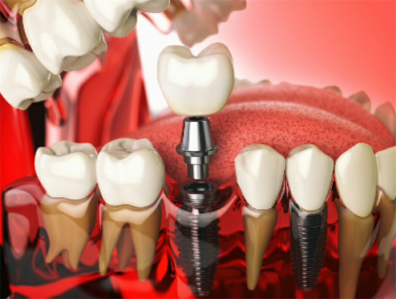 The Future Starts Today: 6 of the Most Important New Dental Implant Technology Trends