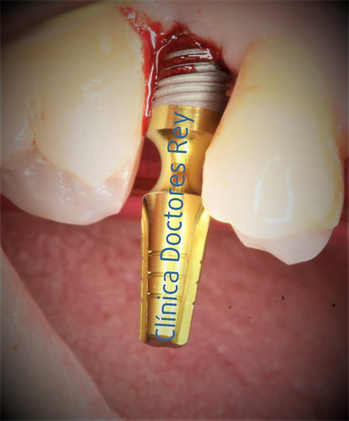 Implantes dentales Valladolid. Midi Técnica One piece implants Dr. Antonio Rey Gil