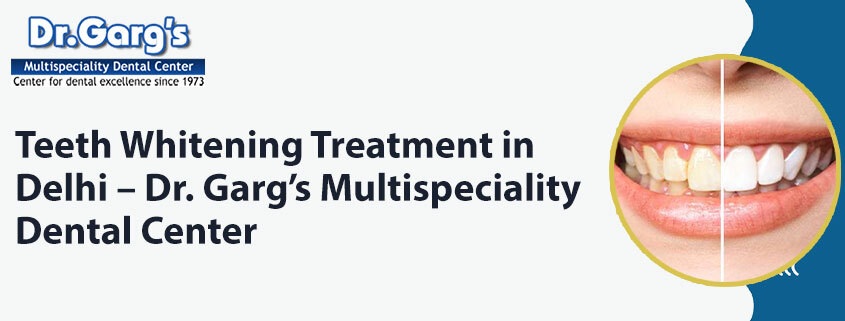 Teeth Whitening Treatment in Delhi – Dr. Garg’s Multispeciality Dental Center
