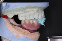 "How to articulate fixed hybrid cases: and assessing restorative space"