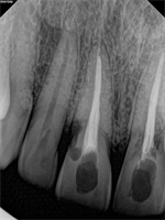 How to Restore Resorption Case?