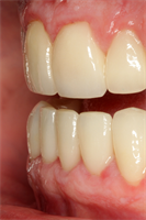 When to Increase OVD?