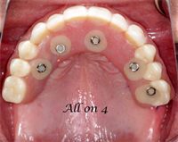 Which Parts Do I Need for "All on 4" Style Cases?