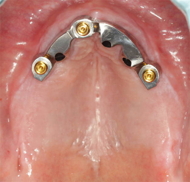Guidelines for Bar Over dentures 