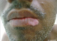 Which microorganism causes syphilis?