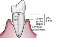 Probe depth is 3mm, recession is 3mm. What is the CAL?