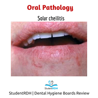 Q: Solar cheilitis is more common in: