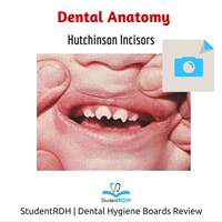 Q: This unusual incisor shape is most likely caused by: