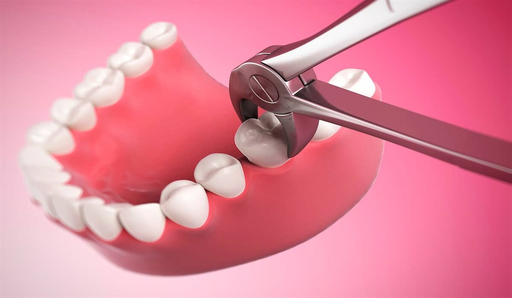 Some Facts About Tooth Extractions and Root Canal Treatments