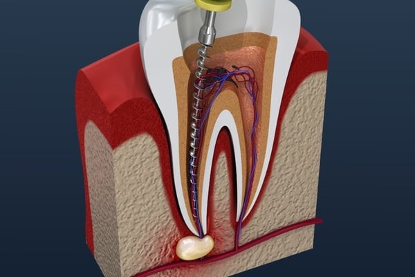 The root of the Problem: A Guide to Root Canal Treatment