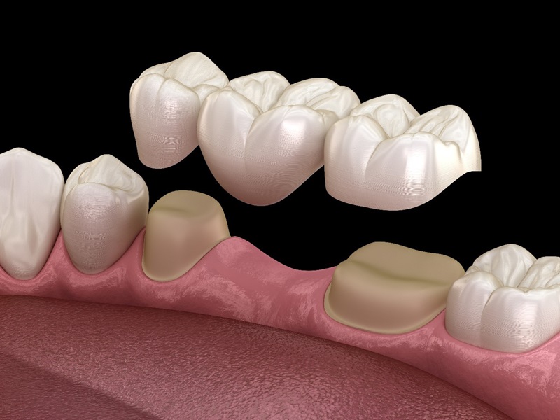 Creating a Lasting Impact with Dental Bridges