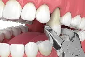Taking Out Troublesome Teeth with Extractions