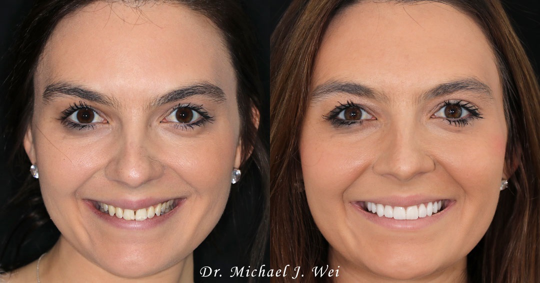 Give Your Smile a Facelift with Veneers