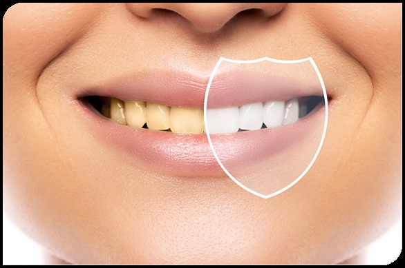 Important Things to Consider Before Getting Teeth Whitening Treatment