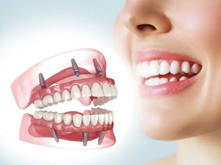 Get a Brand-New Smile: Full Mouth Implants in Turkey Packages
