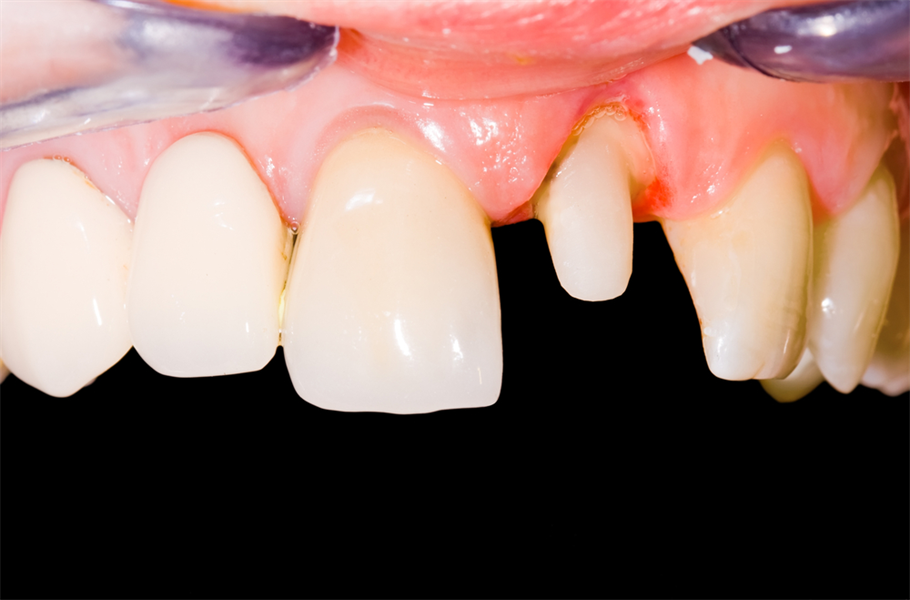 Aesthetic Crown Lengthening Part 3