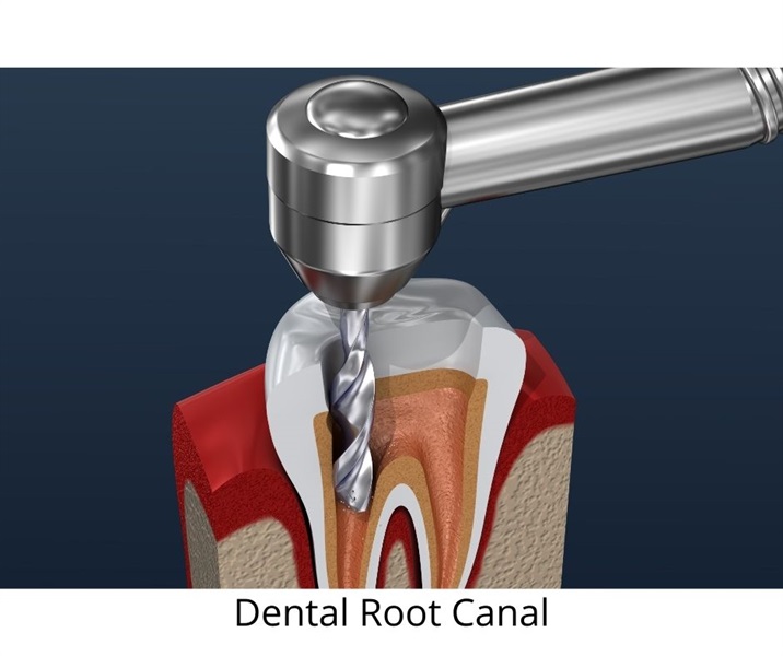 A simple explanation of Root Canal