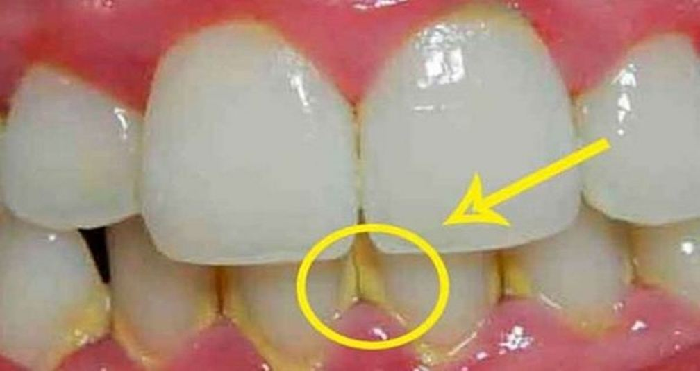 Indications and Contraindications for Coronal Polishing
