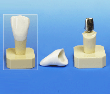 From www.buyamag.com Dental Post Core Model Shows How Restore A Brocken Tooth With Post Core Model 2x Enlarged Natural Size