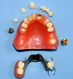 RESTORATION DENTAL MODEL SHOWS VORIETY MOST FREQUENT TECHNIQUES COMBINATIONS USED BY DENTAL DOCTORS
