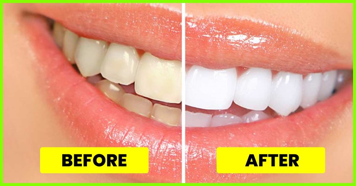 5 Simple Ways to Whiten Your Teeth