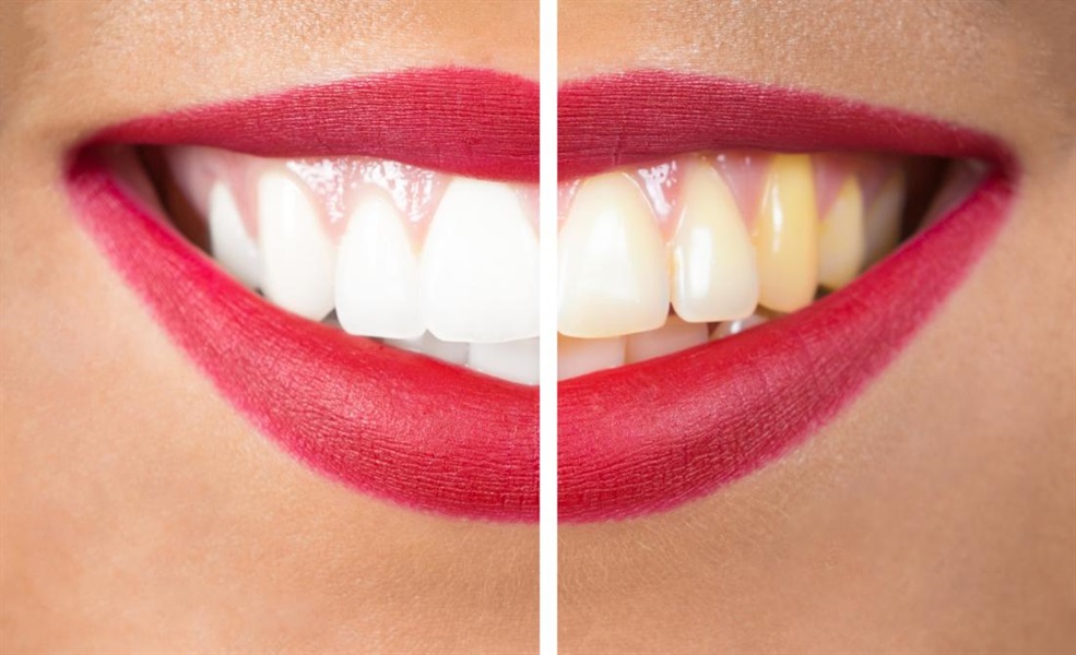 6 Interesting Facts About Teeth Whitening