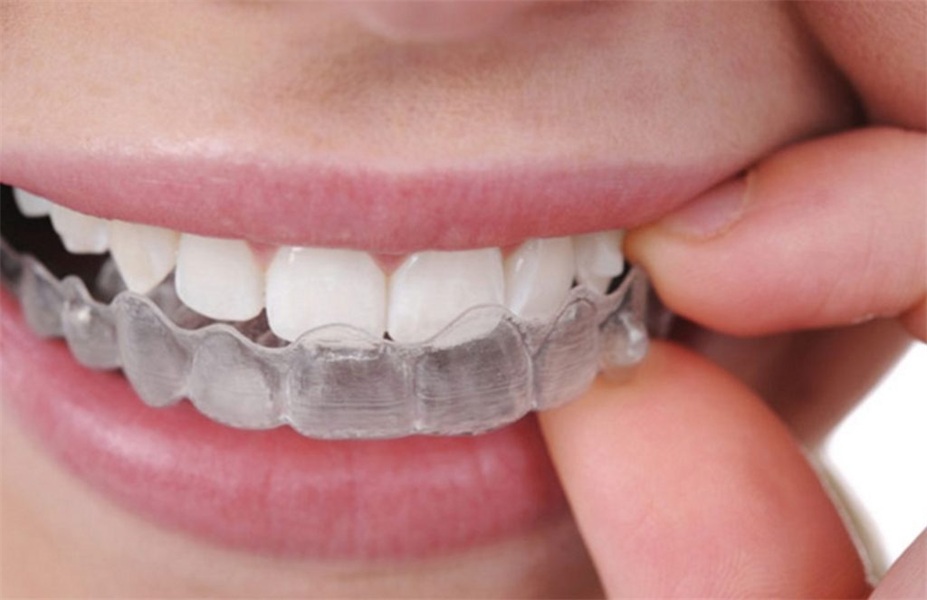 What to Know Before Undergoing Invisalign Treatment
