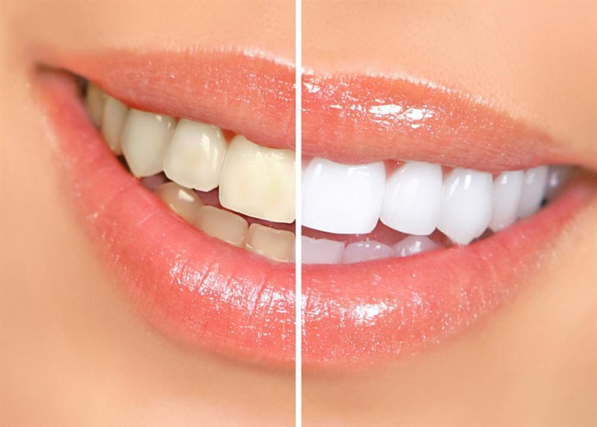 Veneers and Lumineers - The Best Ways to Achieve a Perfect Smile?